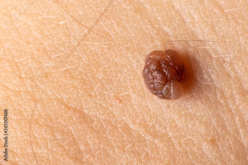 Mole birthmark nevus macro photo on human skin. Close up.