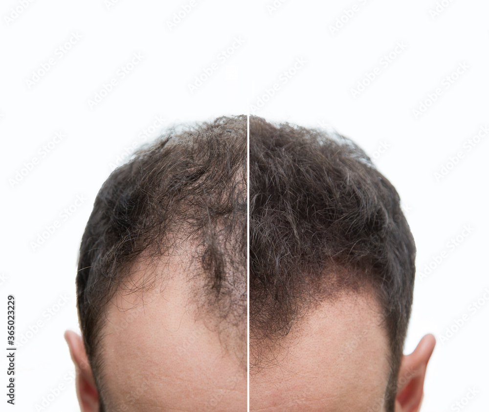 Obraz premium Halbglatze und Geheimratsecken eines Mannes mit Haarausfall - Vorher Nachher - Haarwachstum - Effekt 