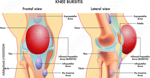 Medical illustration of a knee with an inflamed prepatellar bursa (BURSITIS) viewed frontally and laterally, with annotations.