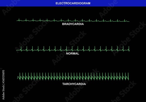 Illustration of different heart rate on electrocardiogram