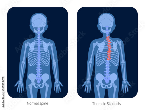 Spine X ray