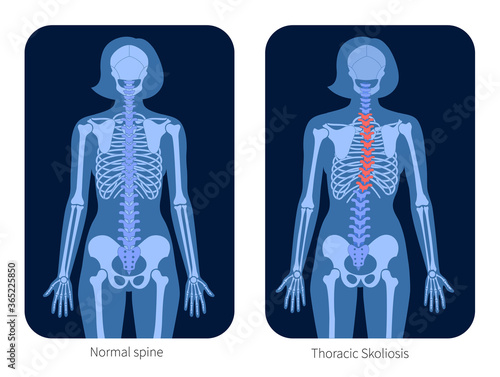 Spine X ray