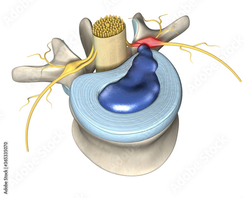Painful herniated disc, slipped disc, medically 3D illustration photo