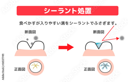 illustrations of dental sealants treatment before after
