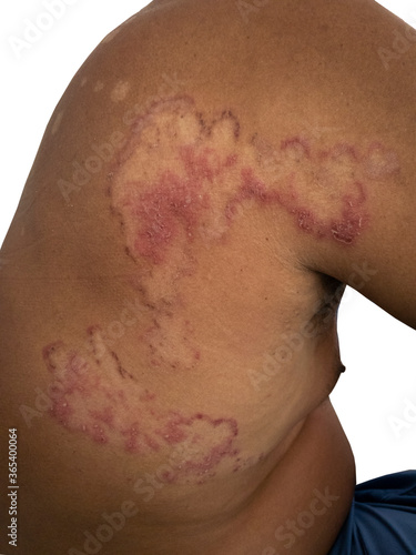 close up of back skin fungal infection , tinea corporis photo