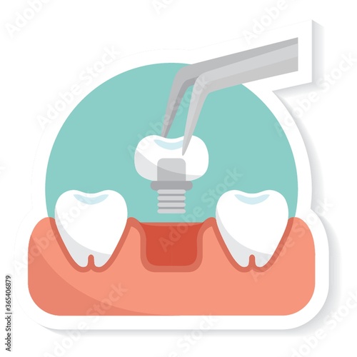 tooth implant