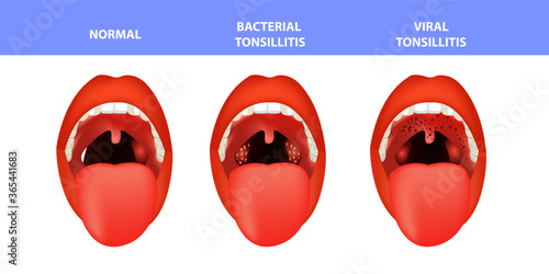 Open mouth, normal and Tonsillitis bacterial and viral. Angina, pharyngitis and tonsillitis. Infection of tonsils.