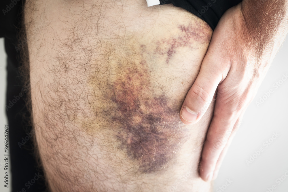 man with big bruise on the thigh. big bruise with bandage. Big blue spot man with big bruise on the thigh. big bruise with bandage. Big blue spot