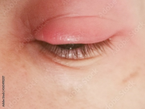 Close up abscess in the eye. hordeolum. stybarley on the eye. inflammation. stye