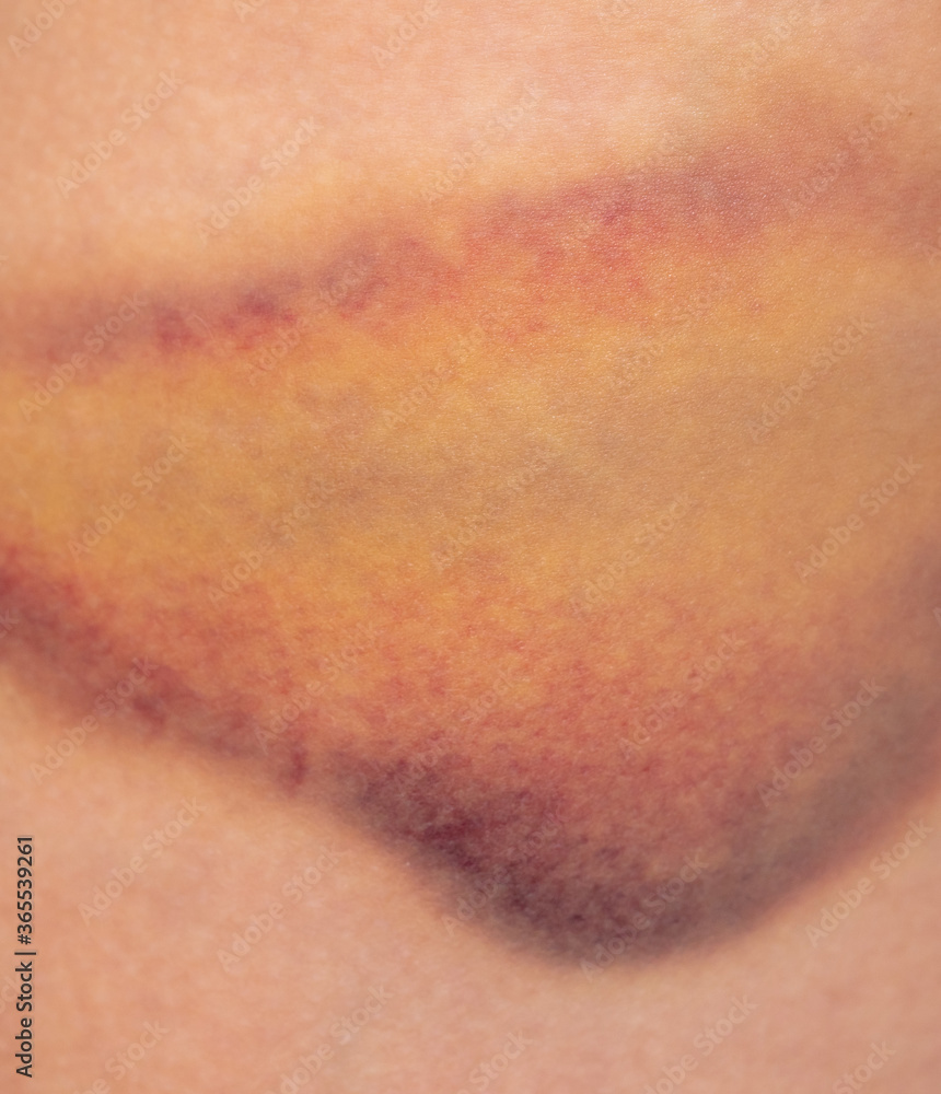Fototapeta premium Closeup bruise on human skin as a background.