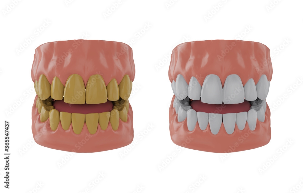 Jaw with yellow teeth, jaw with whitened teeth, Before and after whitening concept, 3d render Jaw with yellow teeth, jaw with whitened teeth, Before and after whitening concept, 3d render