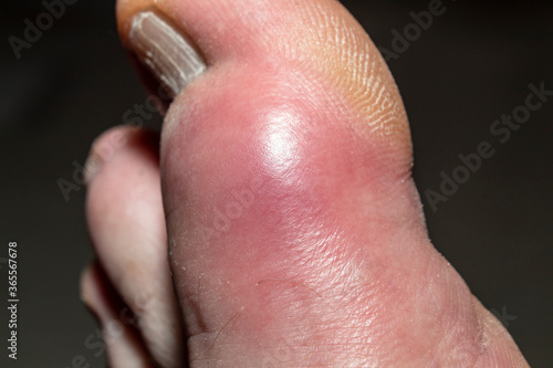 The swelling and redness experienced in the large toe due to Gout and Uric Acid