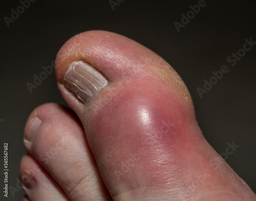 The swelling and redness experienced in the large toe due to Gout and Uric Acid