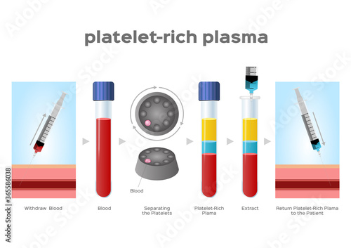 Platelet-Rich plasma procedure stages / prp / Centrifuge vector