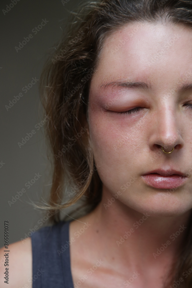 Young caucasian woman with a swollen eye from a wasp's sting. Allergy reaction on wasp bite.	