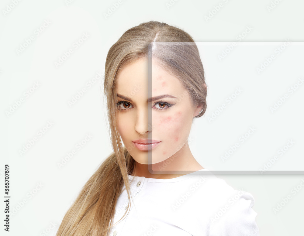 Post-Acne Marks /Treating Acne Scars.Acne Scar Removal Post-Acne Marks /Treating Acne Scars.Acne Scar Removal