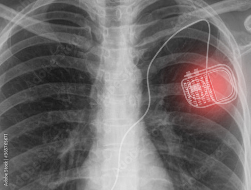 pacemaker implantation photo