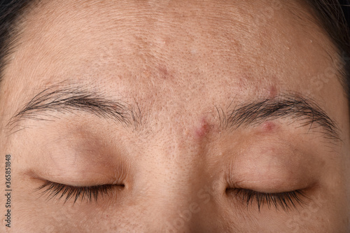 Facial skin problem, Aging problem in adult, wrinkle, acne scar, large pore and dark spot, Dehydrate skin.