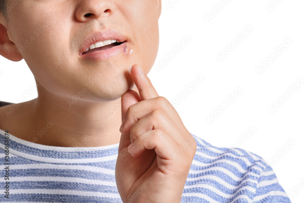 Asian man with cold sore applying ointment on his lips against white background Asian man with cold sore applying ointment on his lips against white background