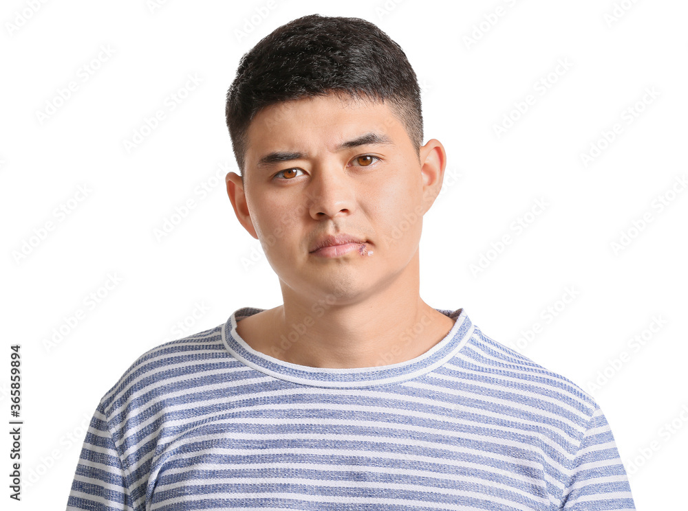 Asian man with cold sore on white background Asian man with cold sore on white background