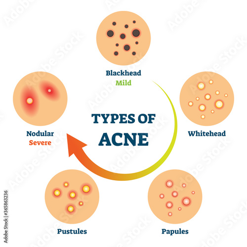 Types of acne as medical skin disease comparison scheme vector illustration