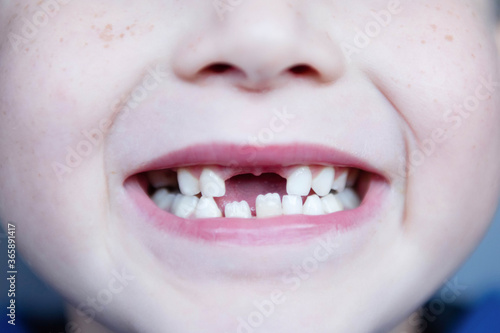 Little boy smiling with the fall of the first baby teeth.