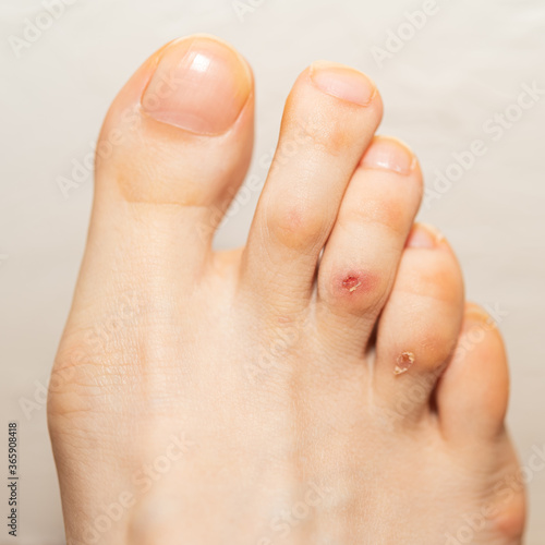A woman’s foot toes with a corn and blisters on them, from wearing heels too often or tight shoes