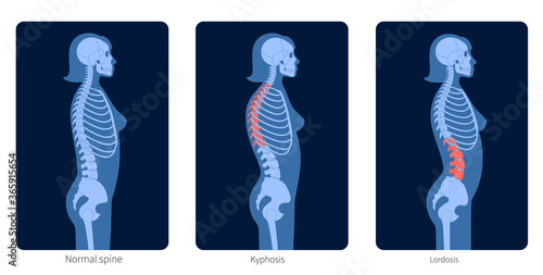 Spine X ray