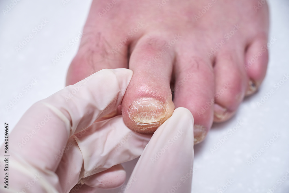 Podiatrist treating feet during procedure, examines the foot. Professional medical pedicure. Podiatry clinic Foot treatment. Podiatrist treating feet during procedure, examines the foot. Professional medical pedicure. Podiatry clinic Foot treatment.
