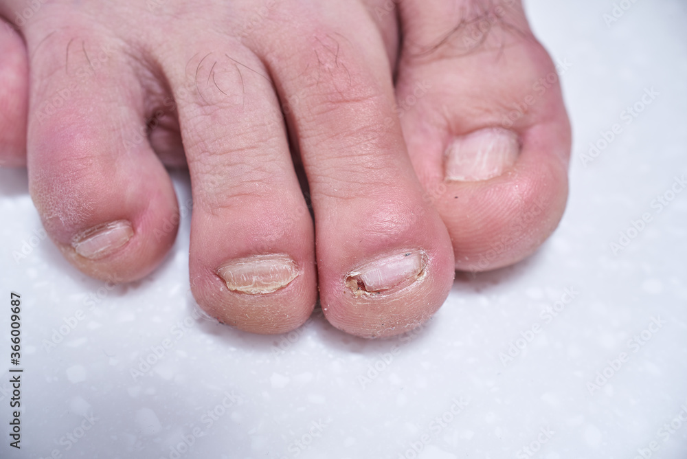 Fototapeta premium Male nails destroyed by onycholysis. Damage to the male foot nails. At the dermatologist doctor. Pedicure and treatment. Isolated on white Close-up of legs