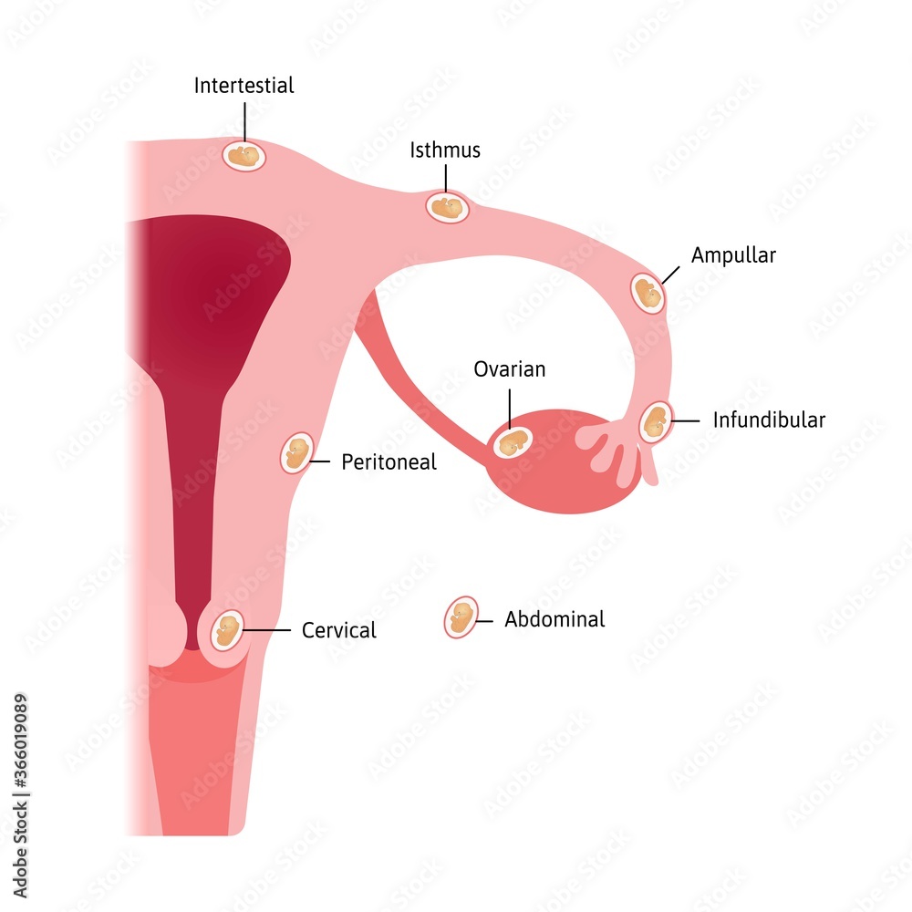 ectopic-pregnancy-occurs-in-a-fallopian-tube-different-types-of-embryo