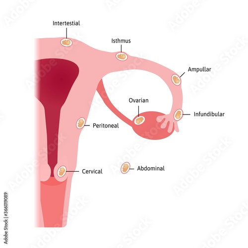 ectopic pregnancy occurs in a fallopian tube. Different types of embryo location. Intertestial, isthmus, ampullar, infundibular, ovarian, peritoneal and cervical. Vector medical illustration marked
