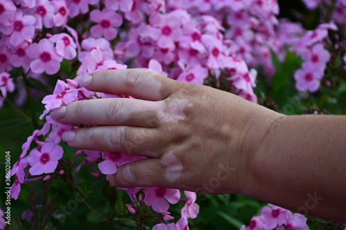 A woman's hand with vitiligo on a background of blooming pink Phlox. Violation of skin pigmentation. White pigment spots. Skin without pigment.