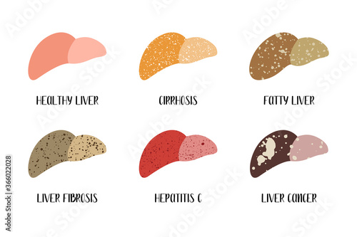 Healthy liver and various liver diseases. Hepatology. Stages of liver damage. Cirrhosis, fatty, fibrosis, hepatitis c, cancer. Vector flat illustration. Perfect for flyer, medical brochure, banner