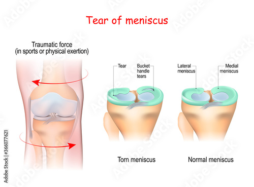 tear of a meniscus. Torn meniscus.