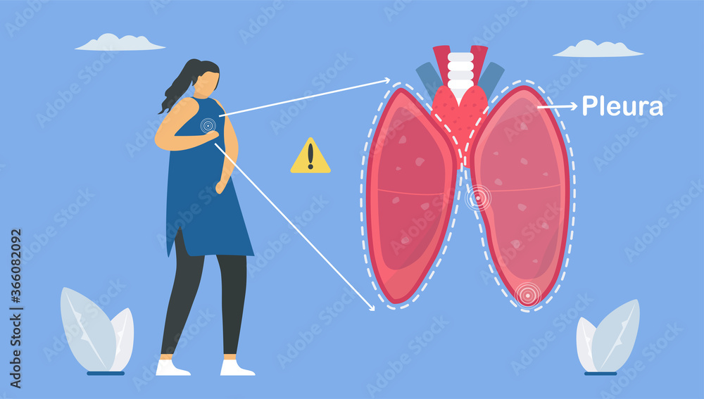 Pleurisy is pleura that separate lungs from chest wall. And it inflamed. Pulmonology