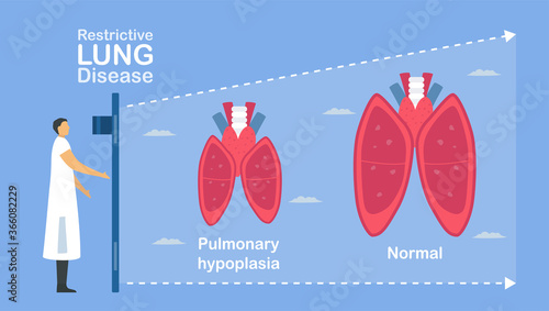 Pulmonary hypoplasia is incomplete  of lungs. It causes low size of alveoli. Pulmonology about restrictive lung disease. photo