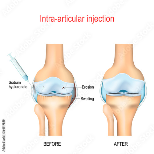 Hyaluronic acid injection for knee osteoarthritis