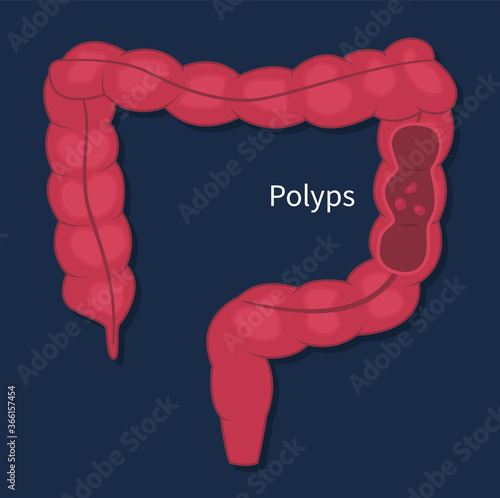 Colonoscopy endoscopic examination of the large bowel. Colorectal cancer screening. Flat vector illustration of polyps removing procedure on black background.