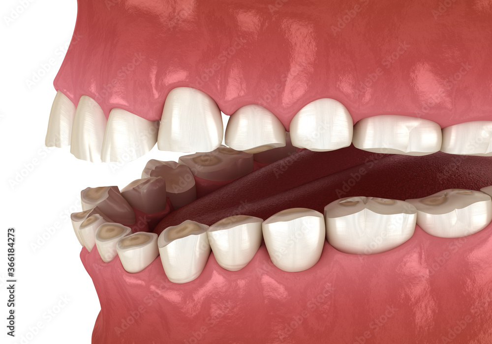 Dental attrition (Bruxism) resulting in loss of tooth tissue. Medically accurate tooth 3D illustration Dental attrition (Bruxism) resulting in loss of tooth tissue. Medically accurate tooth 3D illustration
