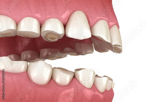 Dental attrition  Bruxism  resulting in loss of tooth tissue.  Medically accurate tooth 3D illustration