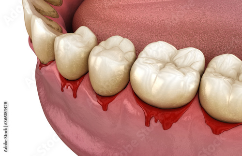 Fototapeta Bleeding gums or Periodontal - pathological inflammatory condition of the gum and bone support