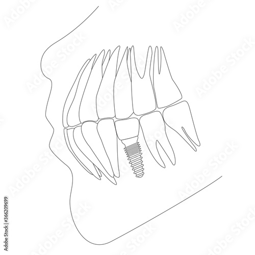 Tooth replacement. Dental implant concept. Vector scheme illustration.