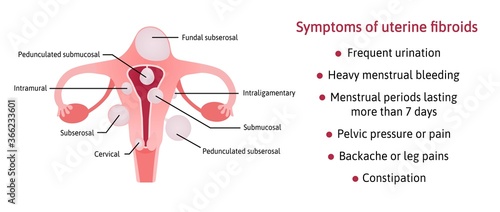 Uterine fibroids and its symptoms. List of symptoms. Different locations inside womb subserosal, submucosal, pedunculated, cervical. fibroids are marked with lines. Vector medical illustration