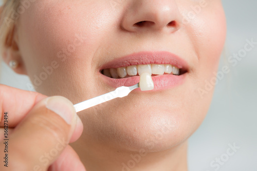Close up of dentist using shade guide at woman's mouth to check veneer of teeth for bleaching