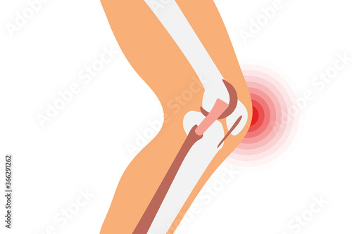 Joint pain illustration. Bone pain. Ache. Arthritis. Orthopedic medical icon. Human leg anatomy.