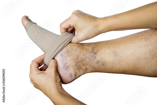 Canvastavla a woman puts a compression stocking on her leg with varicose veins