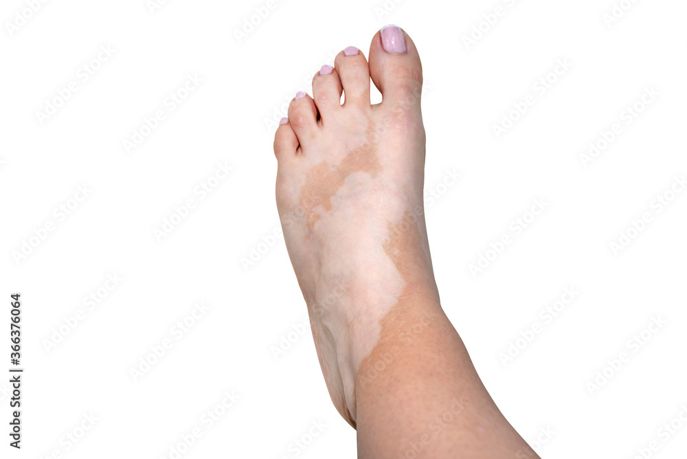 Stains from vitiligo disease on the left foot in a young Caucasian woman, isolated on a white background with a clipping path. Stains from vitiligo disease on the left foot in a young Caucasian woman, isolated on a white background with a clipping path.