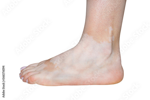 Stains from vitiligo disease on the left foot in a young Caucasian woman, isolated on a white background with a clipping path. © Michal