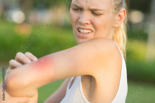 Itchy mosquito bite. Annoyed female person scratching her painful red swollen insect bite on her arm during a summer day at the park.